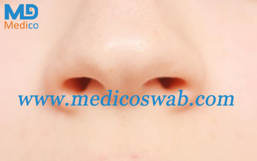 Nasal Swabs Could Help Diagnose Lung Cancer