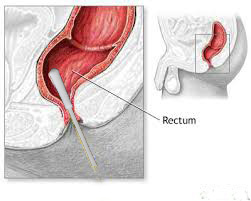 Hisopo de muestreo intestinal rectal