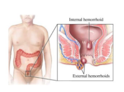 Varilla de muestreo intestinal rectal & hisopo de muestreo