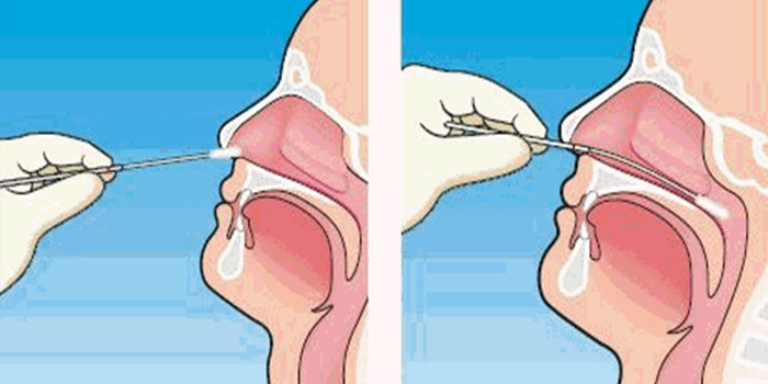 Swab nasofaríngeo médico